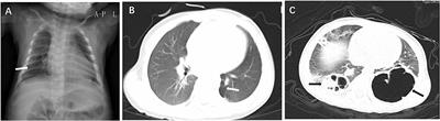 Persistent Pulmonary Interstitial Emphysema With Respiratory Infection: A Clinicopathological Analysis of Six Cases and Detection of Infectious Pathogens by Metagenomic Next-Generation Sequencing (mNGS)